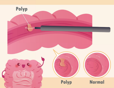 Polyps